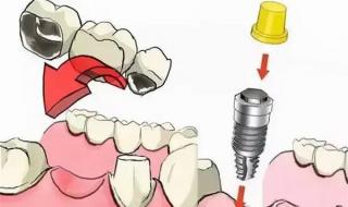 一般种植牙大概是多少钱 种植多少钱一颗